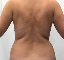 Back Liposuction before
