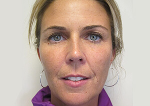 botox facelift