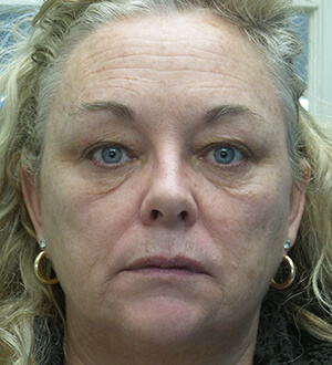 botox facelift