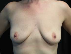Breast Lift Before