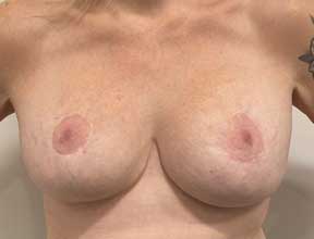 breast implant removal after