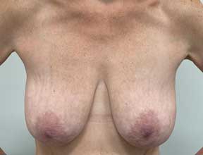 breast implant removal before