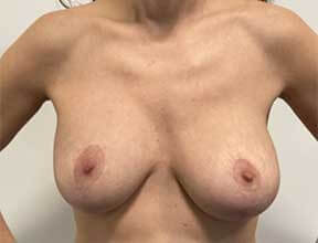 Breast Lift After