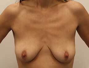 Breast Lift Before