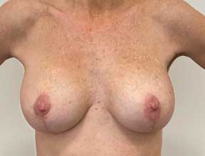breast lift with gel augmentation after