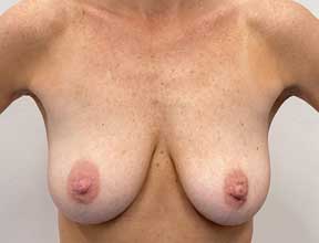 breast lift with gel augmentation before