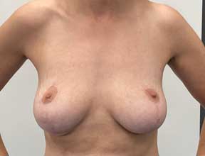 breast implant exchange before