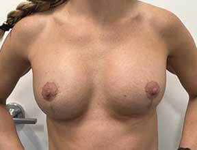 breast implant exchange after