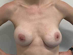 breast implant exchange after