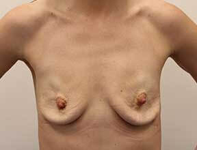 breast implant exchange after