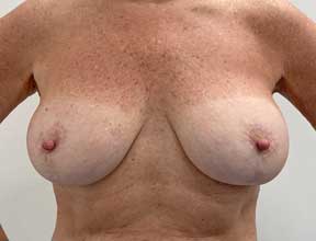 breast implant removal after