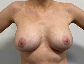 Breast Lift After