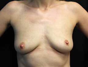 Breast Lift Before