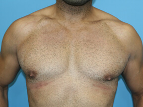 gynecomastia before after
