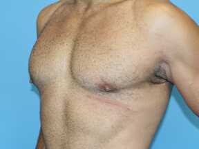 male breast reduction - after