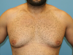 gynecomastia before