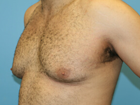 male breast reduction - before