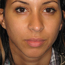 radiesse chin after