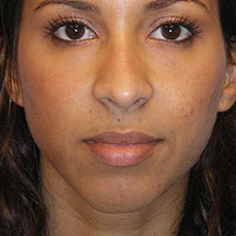 radiesse chin before