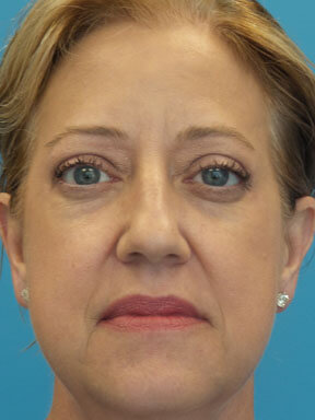 Radiesse After