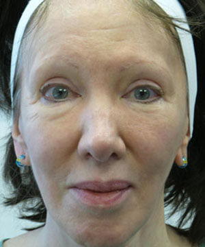 radiesse before