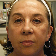 Radiesse Before