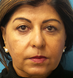 Radiesse Before