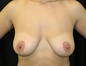 Breast Lift Before