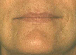 lips after