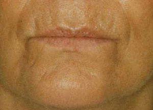 lips before