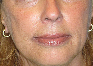 radiesse and restylane after
