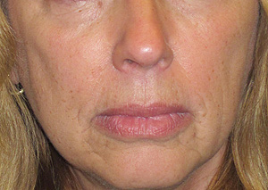 radiesse and restylane before