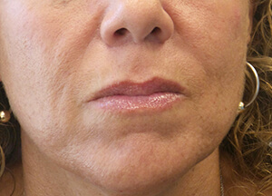 lips after