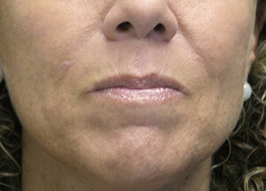 lips before