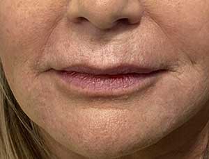 RHA marionette lines after