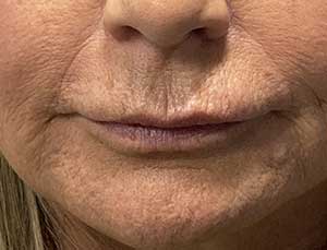 RHA marionette lines before