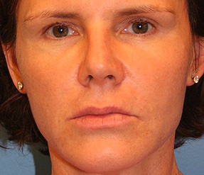 sculptra after