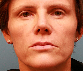 sculptra before and after