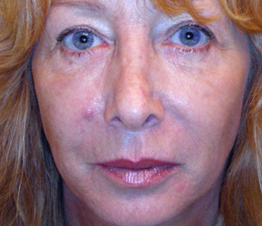 sculptra after