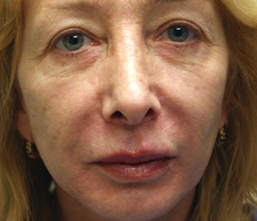 sculptra before