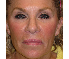 sculptra after