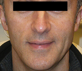 sculptra after