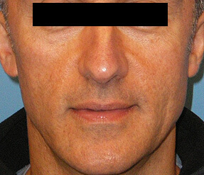 sculptra before and after