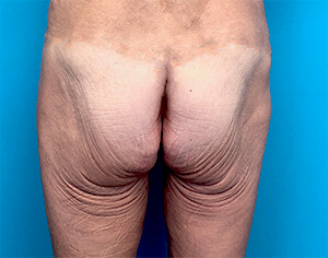 sculptra butt lift - before