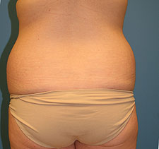 slimlipo back before