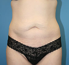 slimlipo after