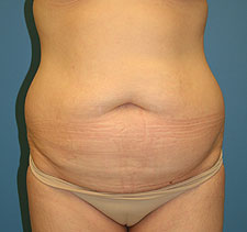 SlimLipo before