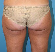 slim lipo before