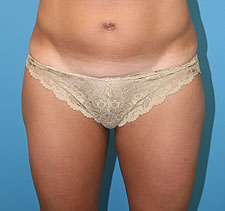 slim lipo before