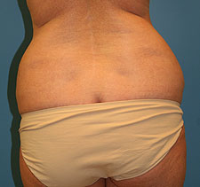 slimlipo back before